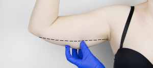 Arm Lift Surgery Specialist Near Me in Miami Beach, FL