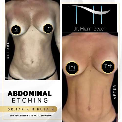Abdominal Etching Female Gallery at Dr. Miami Beach in Miami Beach, FL