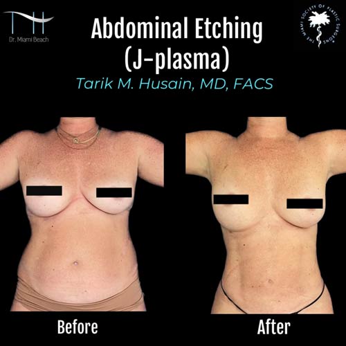 Abdominal Etching Female Gallery at Dr. Miami Beach in Miami Beach, FL