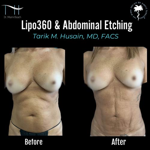 Abdominal Etching Female Gallery at Dr. Miami Beach in Miami Beach, FL