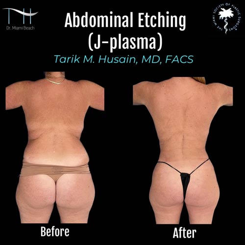 Abdominal Etching Female Gallery at Dr. Miami Beach in Miami Beach, FL