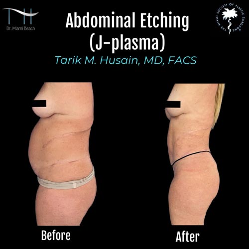 Abdominal Etching Female Gallery at Dr. Miami Beach in Miami Beach, FL
