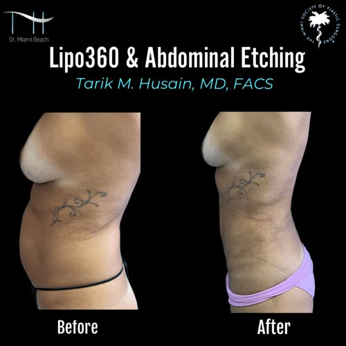 Abdominal Etching Female Gallery at Dr. Miami Beach in Miami Beach, FL