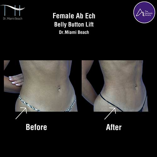Abdominal Etching Female Gallery at Dr. Miami Beach in Miami Beach, FL