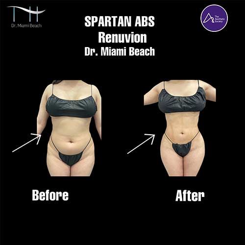 Abdominal Etching Female Gallery at Dr. Miami Beach in Miami Beach, FL
