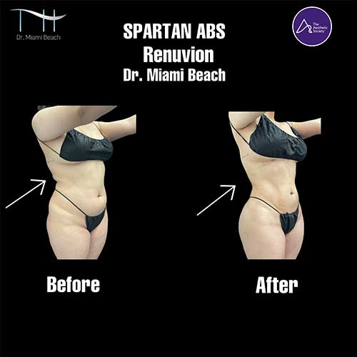 Abdominal Etching Female Gallery at Dr. Miami Beach in Miami Beach, FL