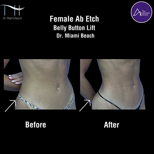 Abdominal Etching Female Gallery at Dr. Miami Beach in Miami Beach, FL