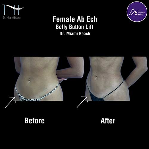 Abdominal Etching Female Gallery at Dr. Miami Beach in Miami Beach, FL