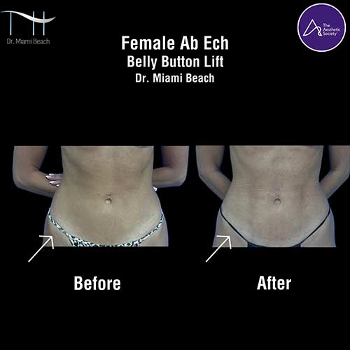 Abdominal Etching Female Gallery at Dr. Miami Beach in Miami Beach, FL
