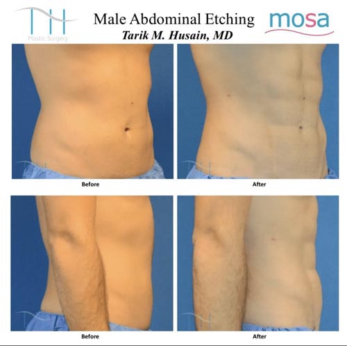 Abdominal Etching Male Gallery at Dr. Miami Beach in Miami Beach, FL