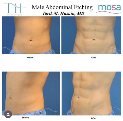 Abdominal Etching Male Gallery at Dr. Miami Beach in Miami Beach, FL
