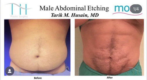 Abdominal Etching Male Gallery at Dr. Miami Beach in Miami Beach, FL