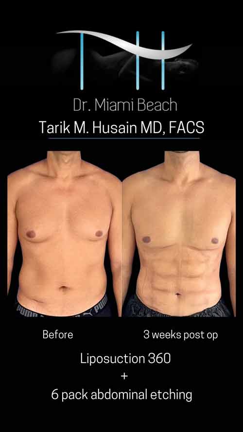 Abdominal Etching Male Gallery at Dr. Miami Beach in Miami Beach, FL