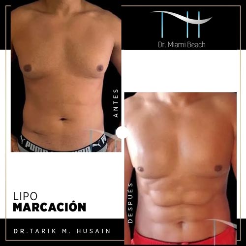 Abdominal Etching Male Gallery at Dr. Miami Beach in Miami Beach, FL
