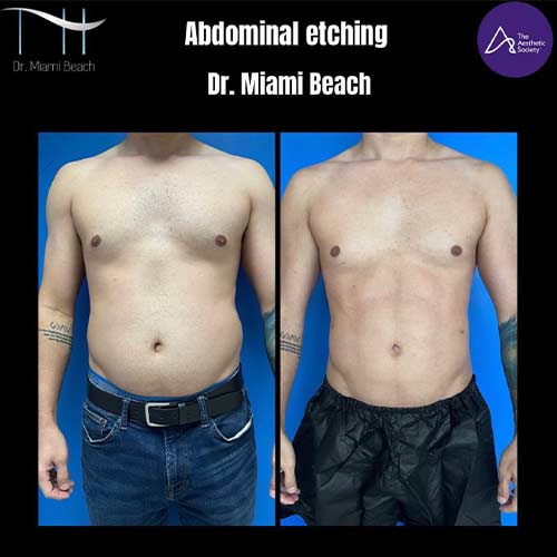 Abdominal Etching Male Gallery at Dr. Miami Beach in Miami Beach, FL