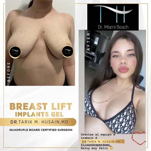 Breast Surgery Gallery at Dr. Miami Beach in Miami Beach, FL