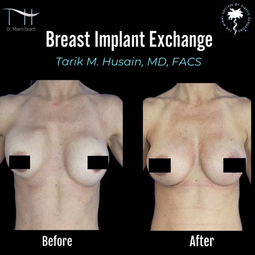 Breast Surgery Gallery at Dr. Miami Beach in Miami Beach, FL