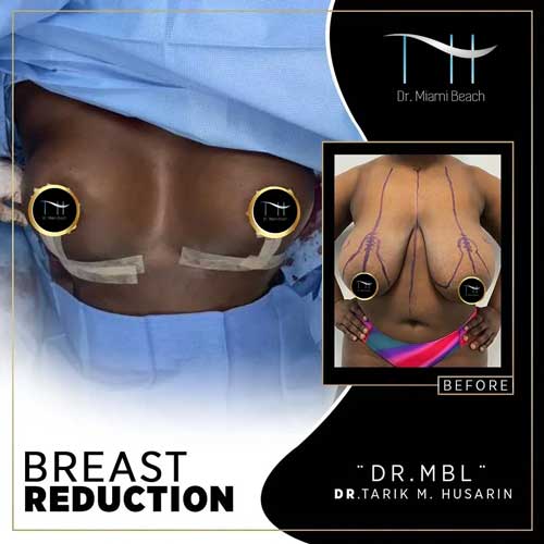 Breast Surgery Gallery at Dr. Miami Beach in Miami Beach, FL