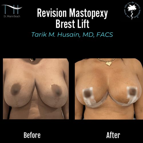 Breast Surgery Gallery at Dr. Miami Beach in Miami Beach, FL