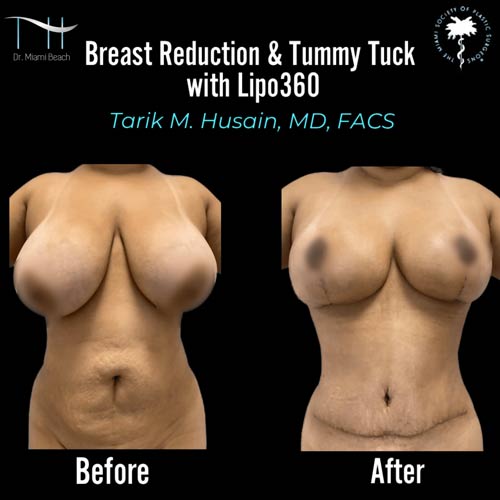 Breast Surgery Gallery at Dr. Miami Beach in Miami Beach, FL