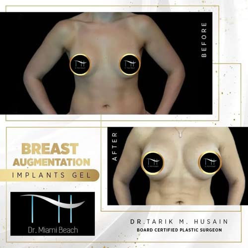 Breast Surgery Gallery at Dr. Miami Beach in Miami Beach, FL