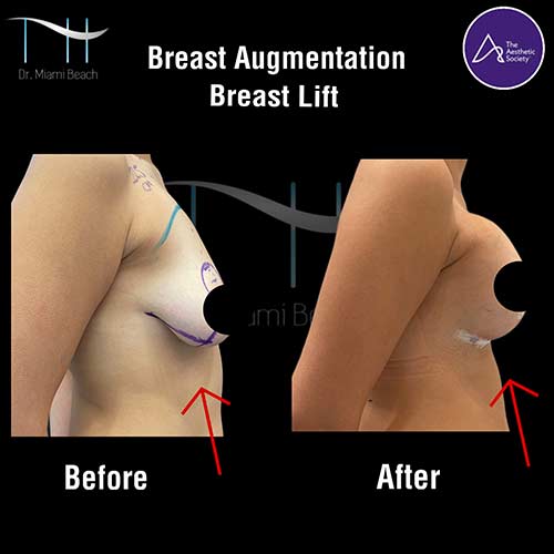 Breast Surgery Gallery at Dr. Miami Beach in Miami Beach, FL