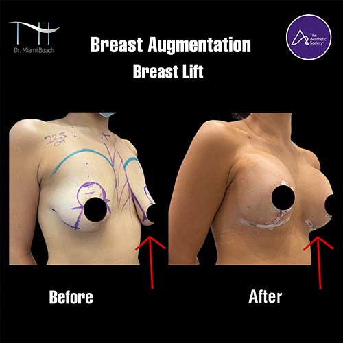Breast Surgery Gallery at Dr. Miami Beach in Miami Beach, FL