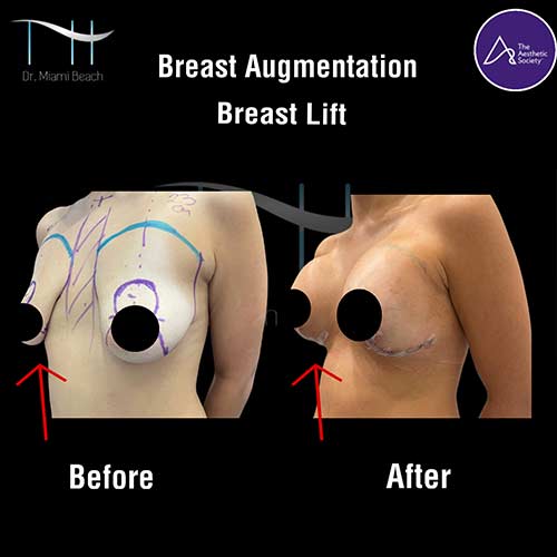 Breast Surgery Gallery at Dr. Miami Beach in Miami Beach, FL