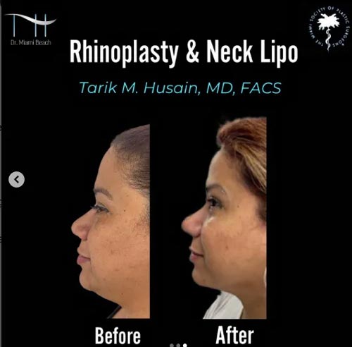 Rhinoplasty and Neck Lipo at Dr. Miami Beach in Miami Beach, FL
