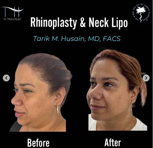 Rhinoplasty and Neck Lipo at Dr. Miami Beach in Miami Beach, FL