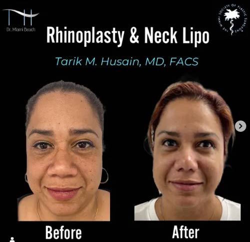 Rhinoplasty and Neck Lipo at Dr. Miami Beach in Miami Beach, FL
