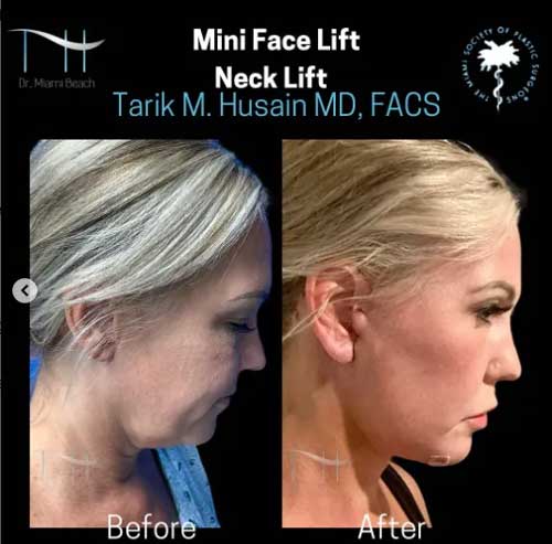Mini Face Lift/Neck Lift at Dr. Miami Beach in Miami Beach, FL
