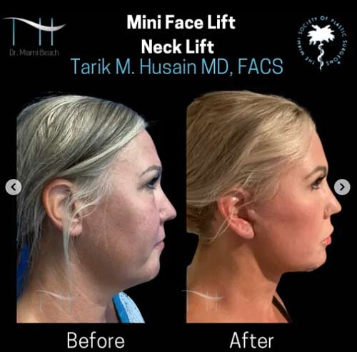 Mini Face Lift/Neck Lift at Dr. Miami Beach in Miami Beach, FL
