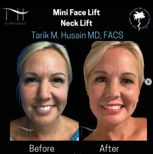 Mini Face Lift/Neck Lift at Dr. Miami Beach in Miami Beach, FL