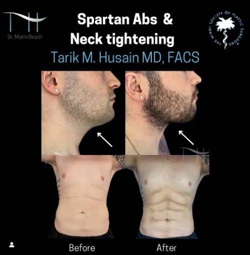 Spartan Abs and Neck Tightening at Dr. Miami Beach in Miami Beach, FL