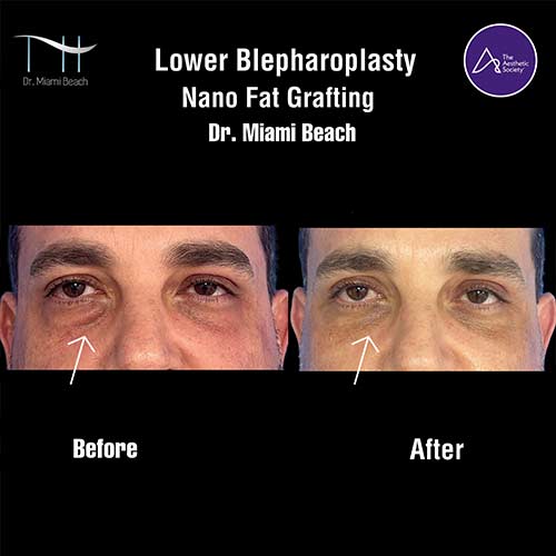 Lower Blepharoplasty at Dr. Miami Beach in Miami Beach, FL