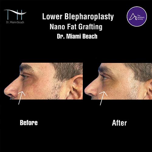 Lower Blepharoplasty at Dr. Miami Beach in Miami Beach, FL