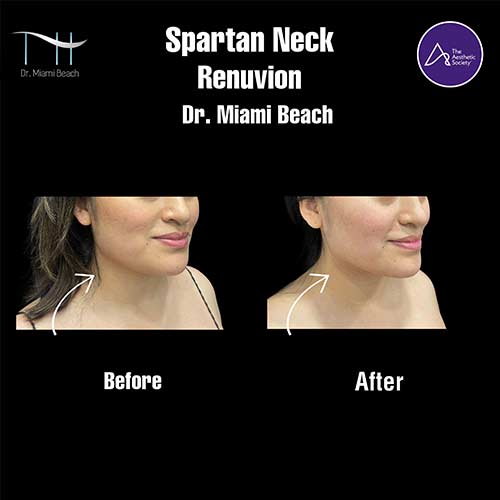 Spartan Neck Renuvion at Dr. Miami Beach in Miami Beach, FL