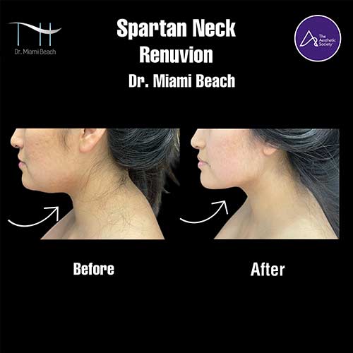 Spartan Neck Renuvion at Dr. Miami Beach in Miami Beach, FL