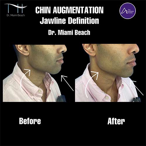 Chin Augmentation at Dr. Miami Beach in Miami Beach, FL