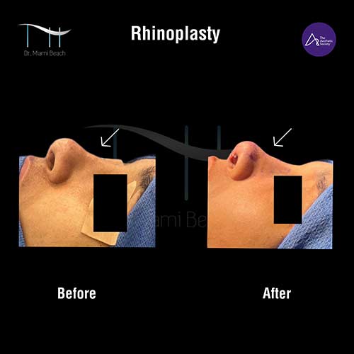 Rhinoplasty at Dr. Miami Beach in Miami Beach, FL