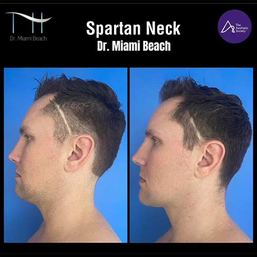 Spartan Neck at Dr. Miami Beach in Miami Beach, FL
