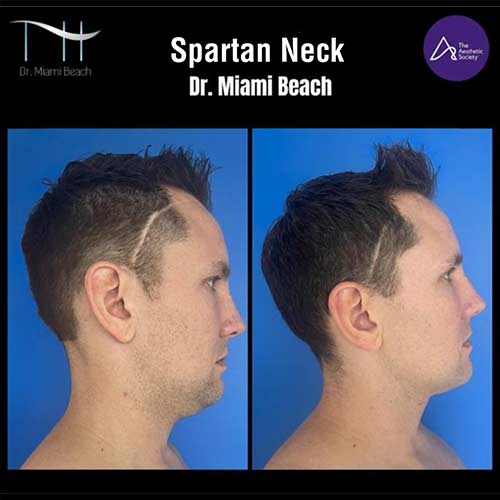 Spartan Neck at Dr. Miami Beach in Miami Beach, FL
