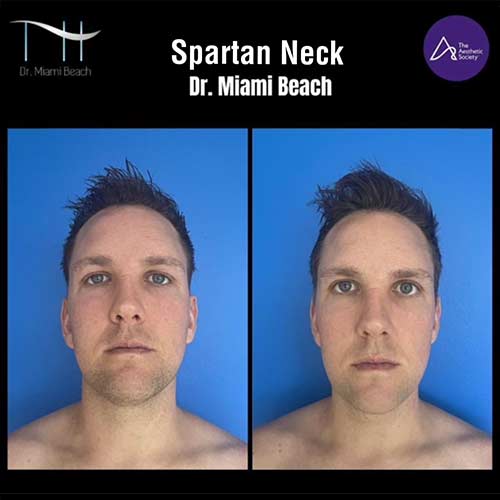 Spartan Neck at Dr. Miami Beach in Miami Beach, FL