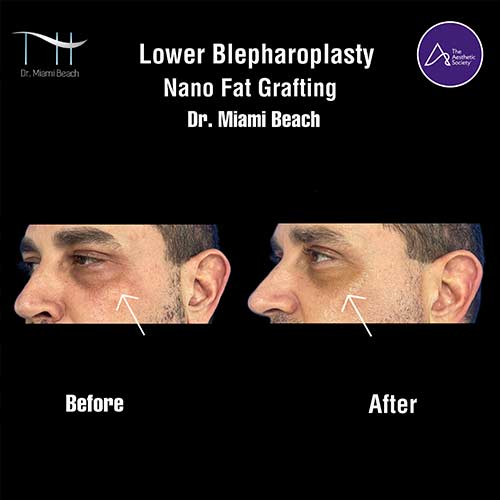 Lower Blepharoplasty at Dr. Miami Beach in Miami Beach, FL