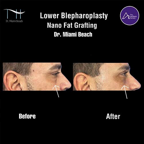 Lower Blepharoplasty at Dr. Miami Beach in Miami Beach, FL