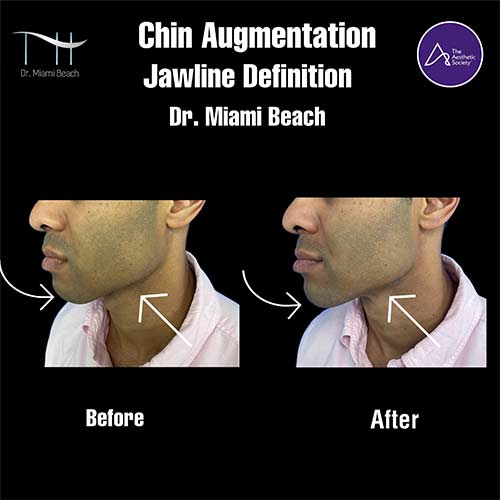 Chin Augmentation at Dr. Miami Beach in Miami Beach, FL