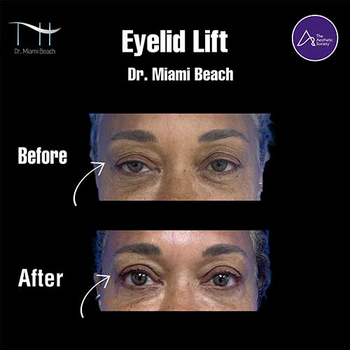 Eyelid Lift Surgery at Dr. Miami Beach in Miami Beach, FL