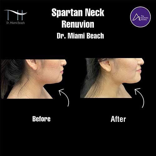 Spartan Neck Renuvion at Dr. Miami Beach in Miami Beach, FL