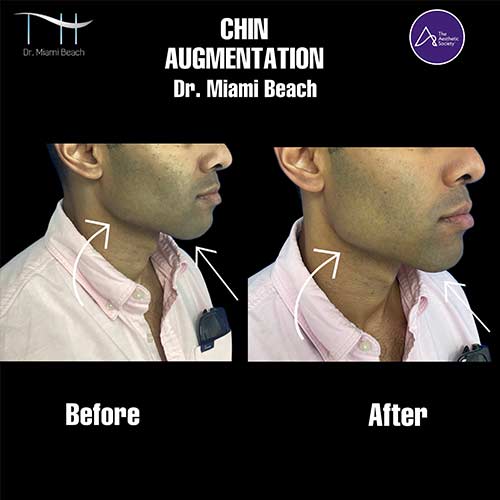 Chin Augmentation at Dr. Miami Beach in Miami Beach, FL